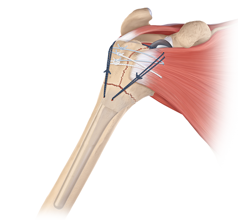 Arthrex - FxBridge Tuberosity Repair System - AR-9517